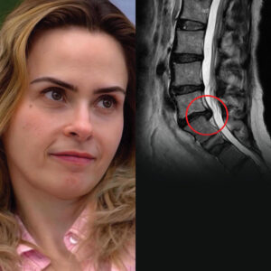 Hérnia de disco afeta Ana Paula Renault FOTO - Reprodução: Instagram