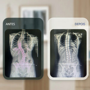Antes e depois da cirurgia de escoliose em adolescente 
